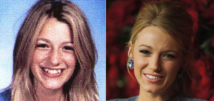 Blake Lively plastic surgery