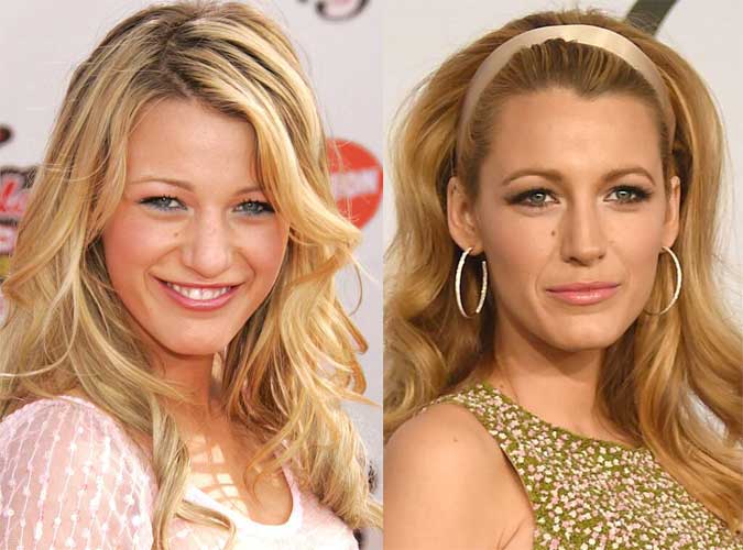 Blake Lively plastic surgery