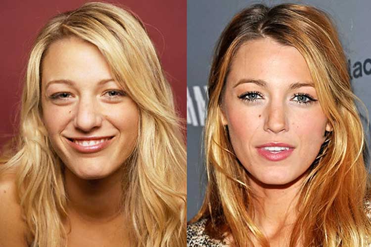 Blake Lively plastic surgery