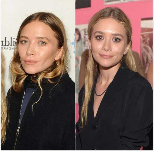 Mary-Kate Olsen plastic surgery