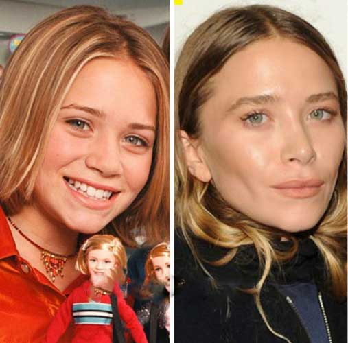 Mary-Kate Olsen plastic surgery