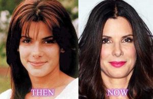 Sandra Bullock Plastic Surgery: Nose job, Facelift, Botox