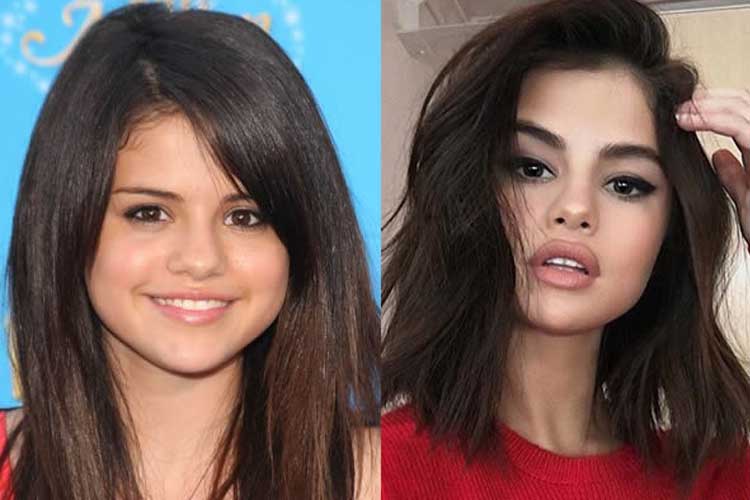 Selena Gomez plastic surgery