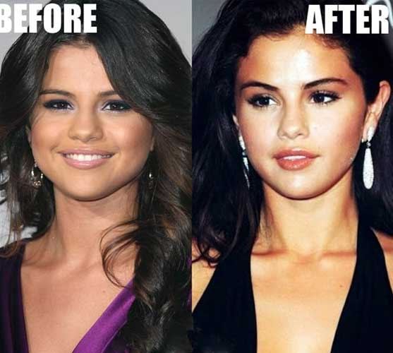 Selena Gomez plastic surgery