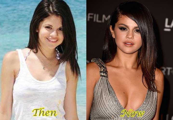 Selena Gomez plastic surgery