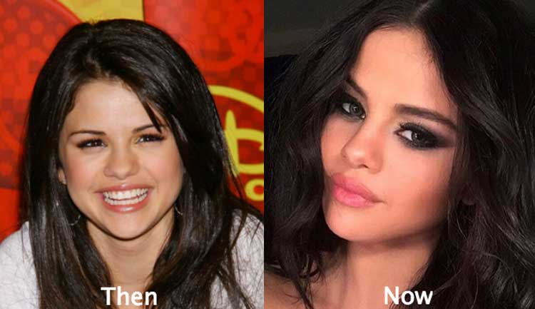 Selena Gomez plastic surgery