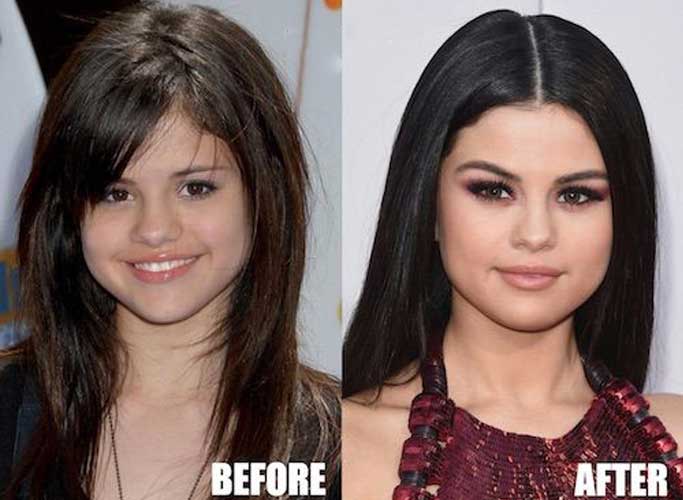 Selena Gomez plastic surgery