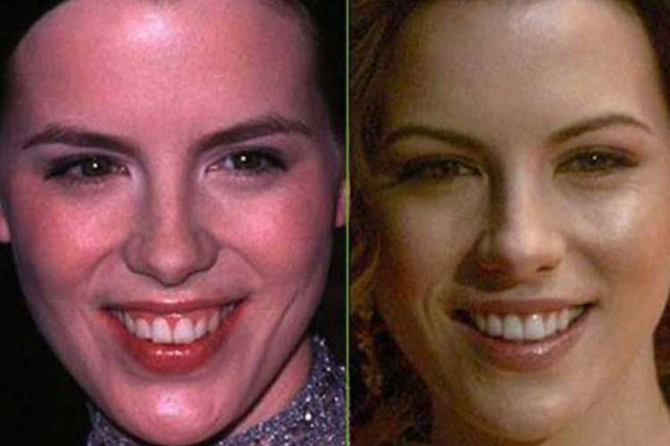 Kate Beckinsale plastic surgery