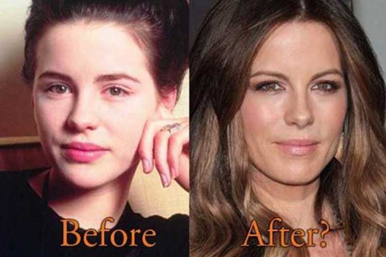 Kate Beckinsale plastic surgery