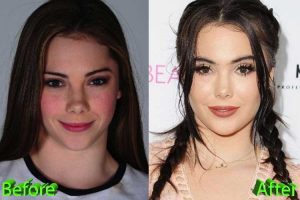 Mckayla Maroney Plastic Surgery: Butt Implant, Lip Fillers, Nose job