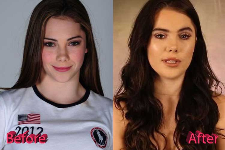 Mckayla Maroney plastic surgery 