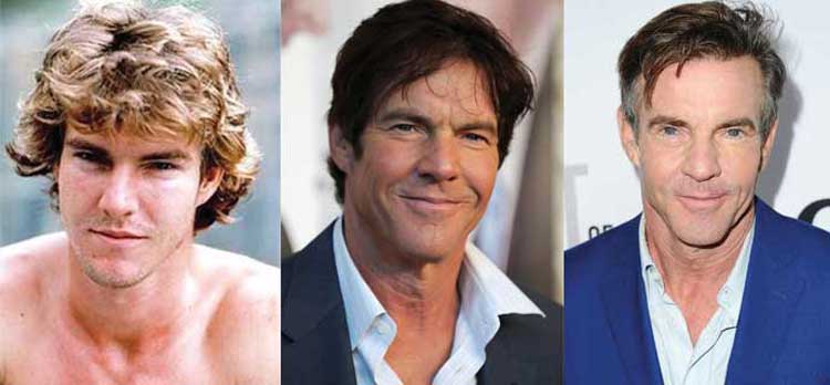 Dennis Quaid Plastic Surgery