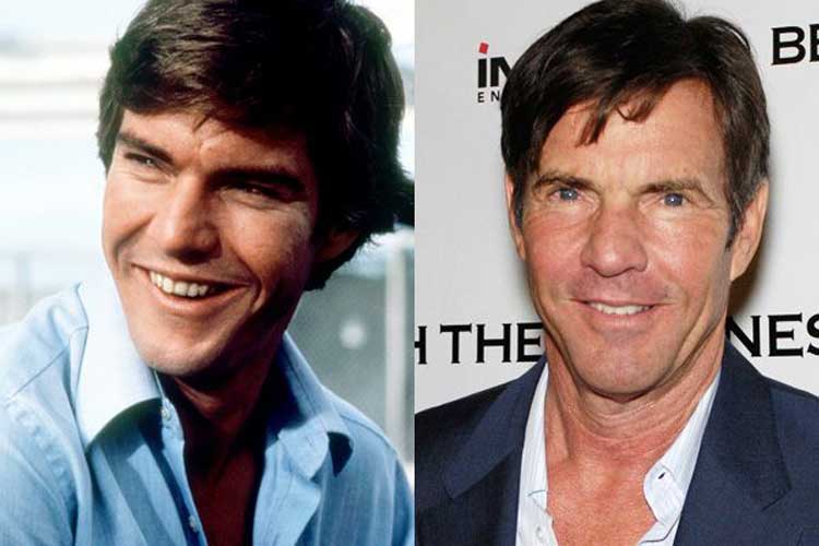 Dennis Quaid Plastic Surgery