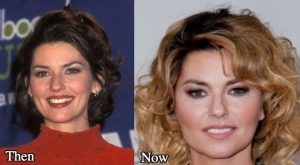 Shania Twain Plastic Surgery: Botox, Cheek Fillers, Nose Job