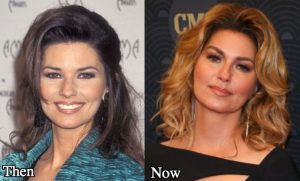 Shania Twain Plastic Surgery: Botox, Cheek Fillers, Nose Job