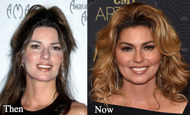 Shania Twain Plastic Surgery