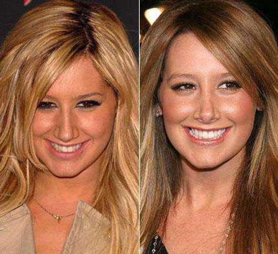 Ashley Tisdale plastic surgery