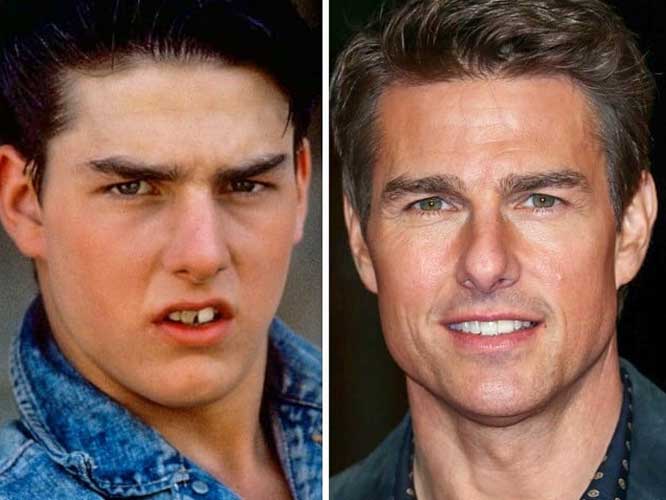 Tom Cruise Plastic Surgery 