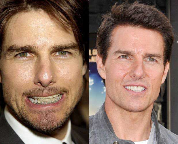 Tom Cruise Plastic Surgery 
