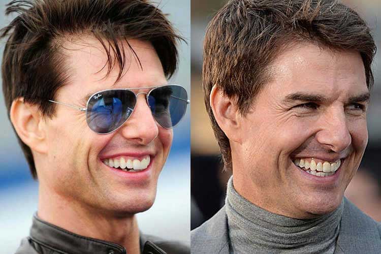 Tom Cruise Plastic Surgery 