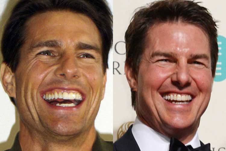 Tom Cruise Plastic Surgery 