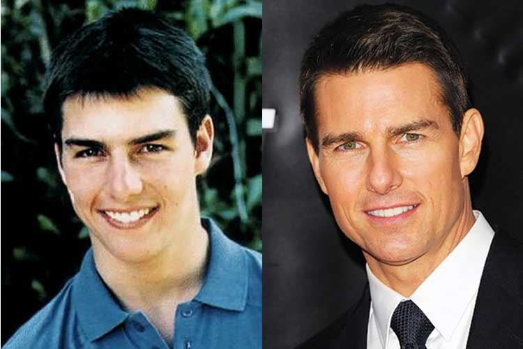 Tom Cruise Plastic Surgery 