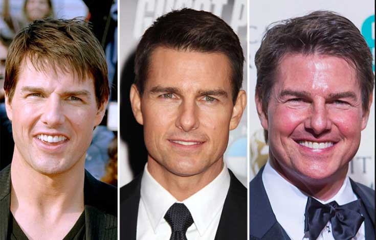 Tom Cruise plastic surgery