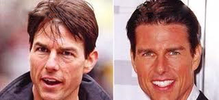 Tom Cruise Plastic Surgery 