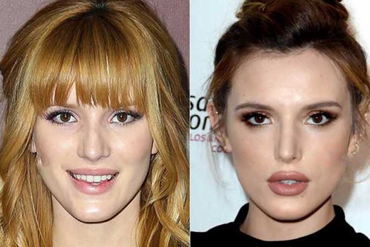 Bella Thorne Plastic Surgery