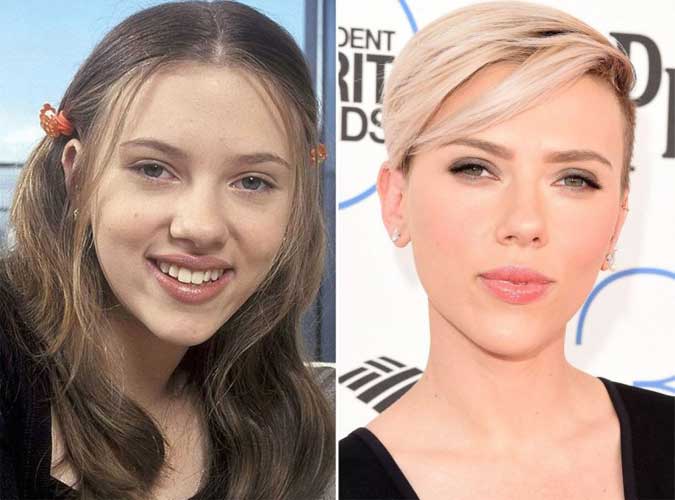 Scarlett Johansson plastic surgery 