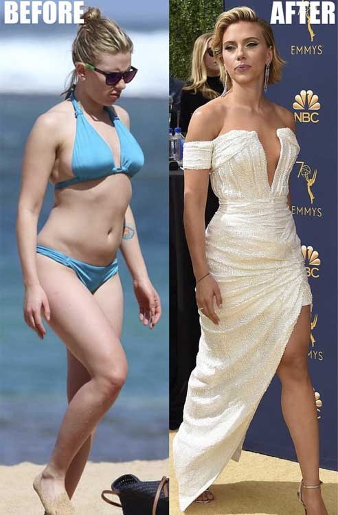 Scarlett Johansson plastic surgery