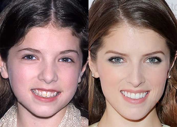 Anna Kendrick Plastic Surgery