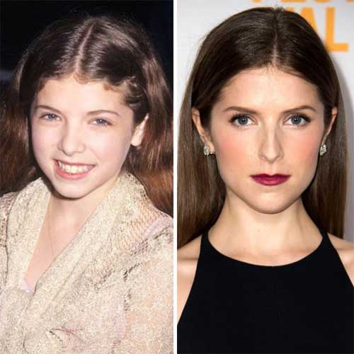 Anna Kendrick Plastic Surgery