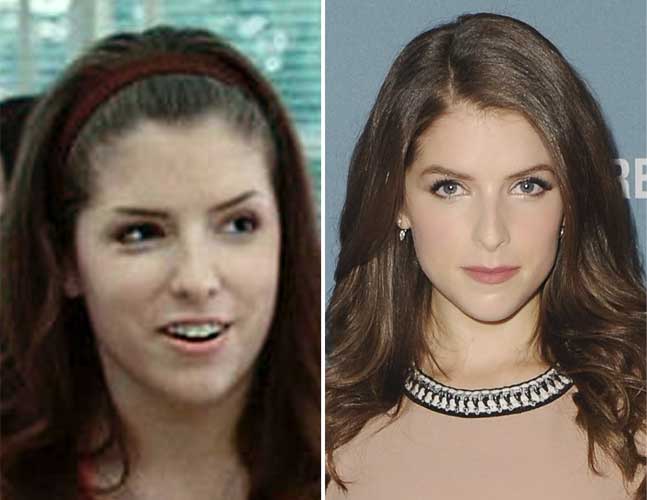 Anna Kendrick plastic surgery