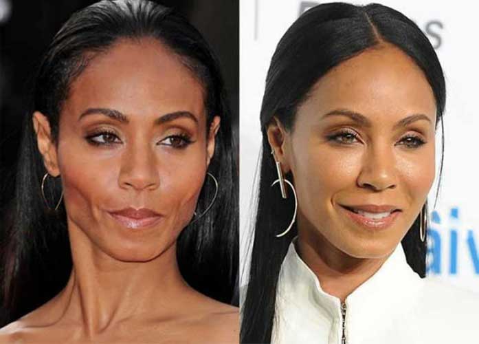 Jada Pinkett Smith Plastic surgery