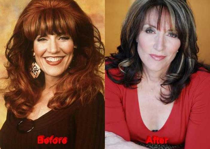 Katey Sagal Plastic Surgery