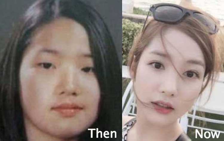 Park Min Young Plastic Surgery 