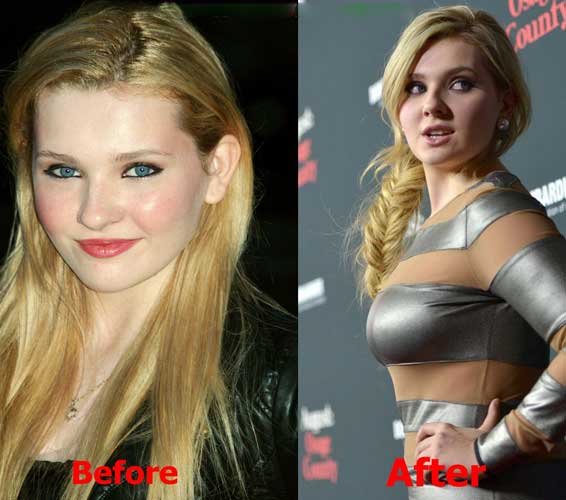 Abigail Breslin Plastic Surgery