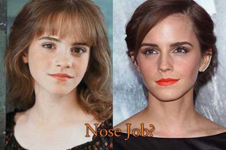 Emma Watson Plastic Surgery