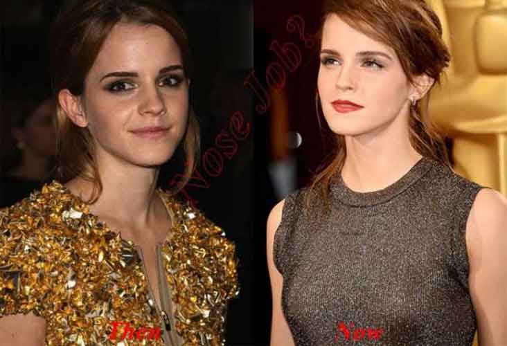 Emma Watson Plastic Surgery