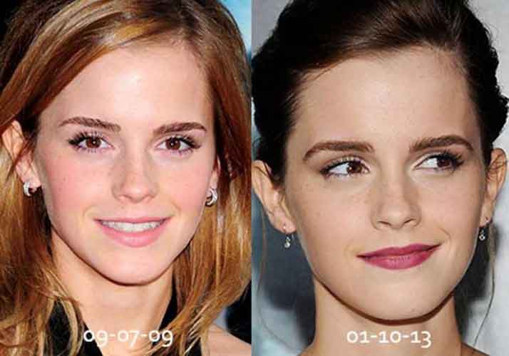 Emma Watson Plastic Surgery Job. 