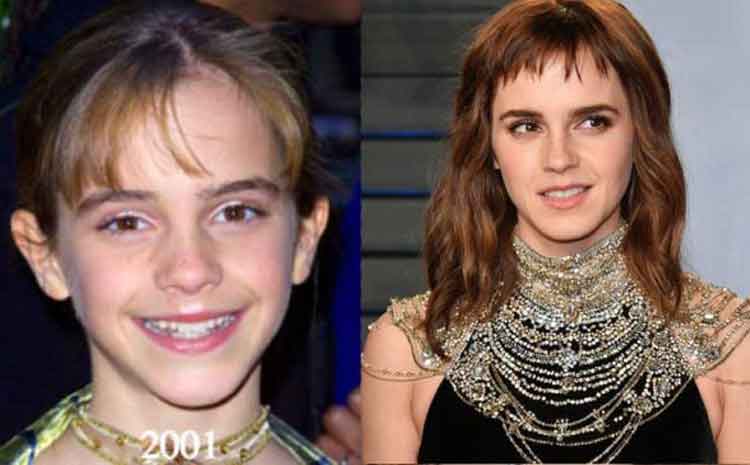 Emma Watson Plastic Surgery