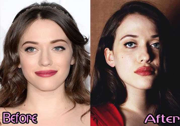 Kat Dennings Plastic Surgery