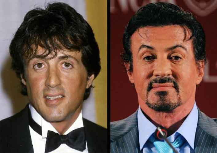 Sylvester Stallone plastic surgery 