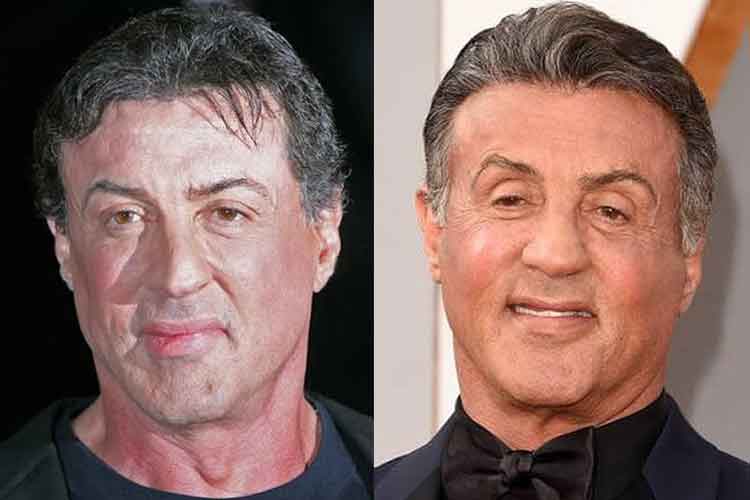 Sylvester Stallone plastic surgery 