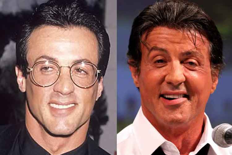 Sylvester Stallone plastic surgery 