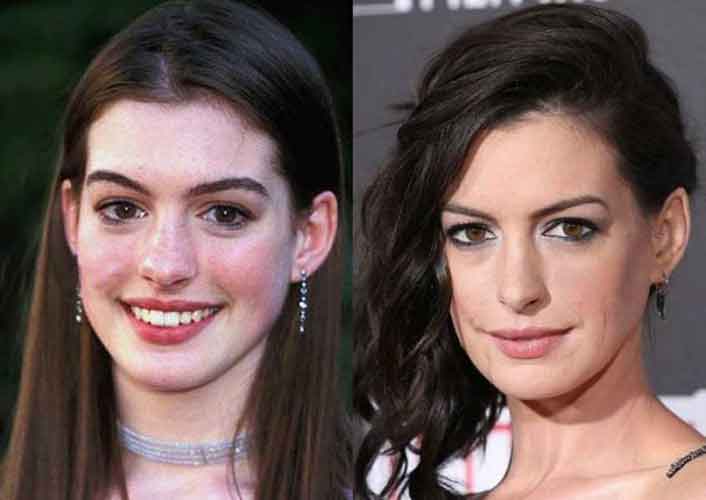 Anne Hathaway Plastic Surgery: Boobs ( Boob Job), Nose Job, Lip Filler