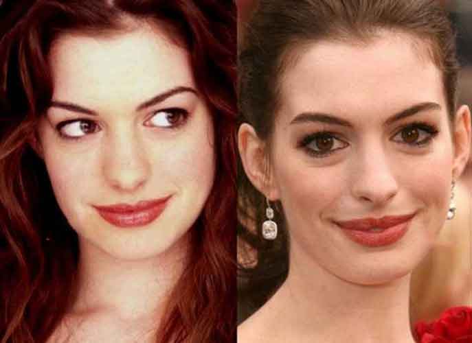 Anne Hathaway Plastic Surgery 