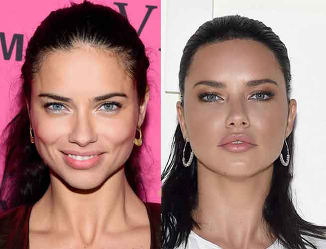 Adriana Lima Plastic Surgery 