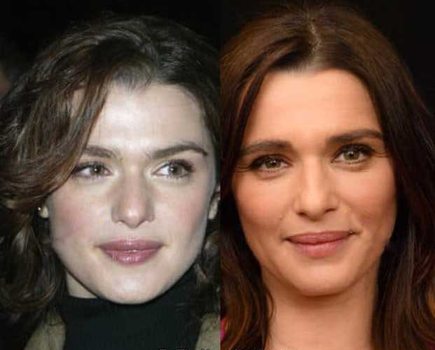 Rachel Weisz Plastic Surgery 